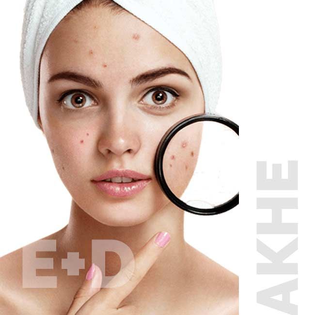 Фотолечение акне